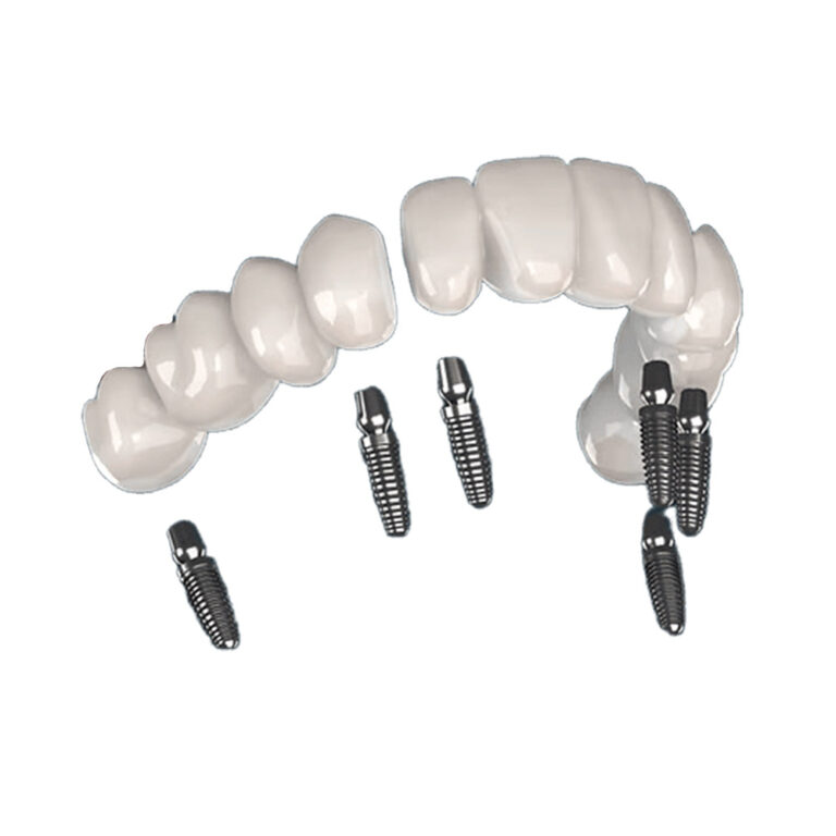 Implantes dentales 3 sobre 6