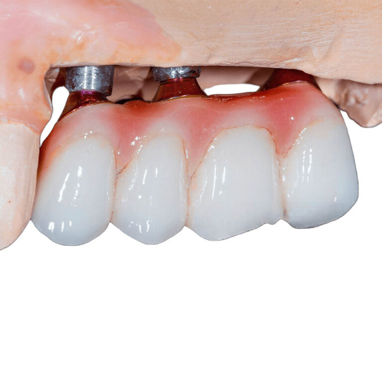 4 tænder på 2 implantater