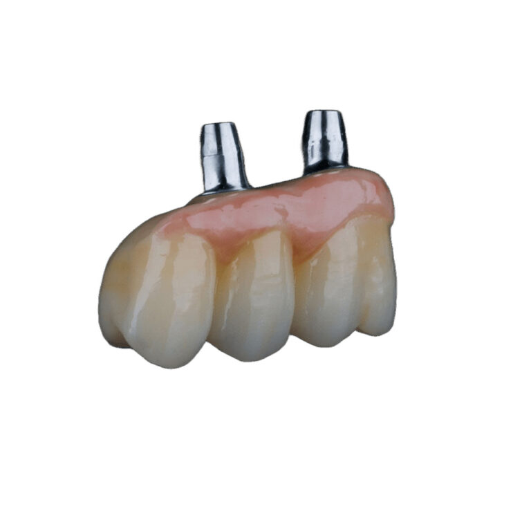 4 tænder på 2 implantater
