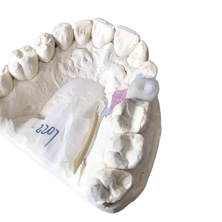 A1 Zirconia Crowns