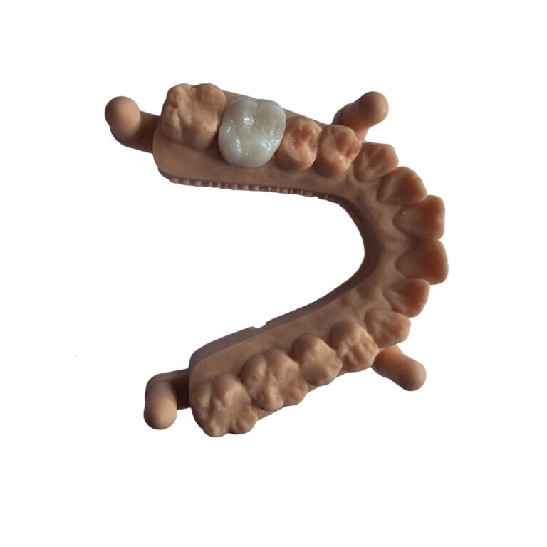 Corona de circonio A2