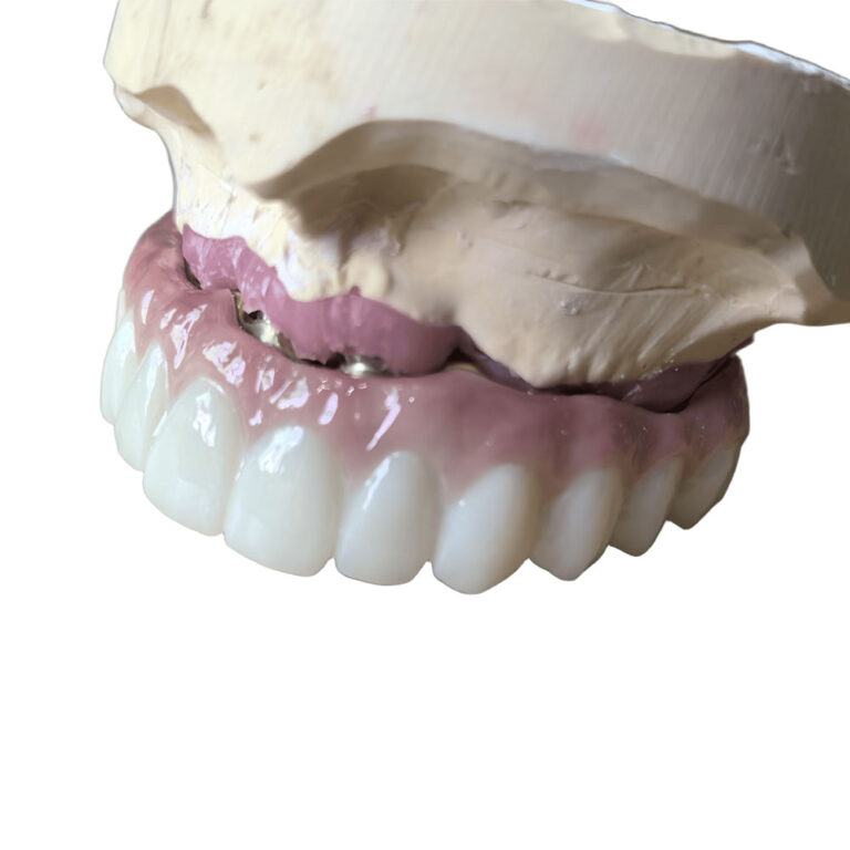 All On 5 Dental Implants