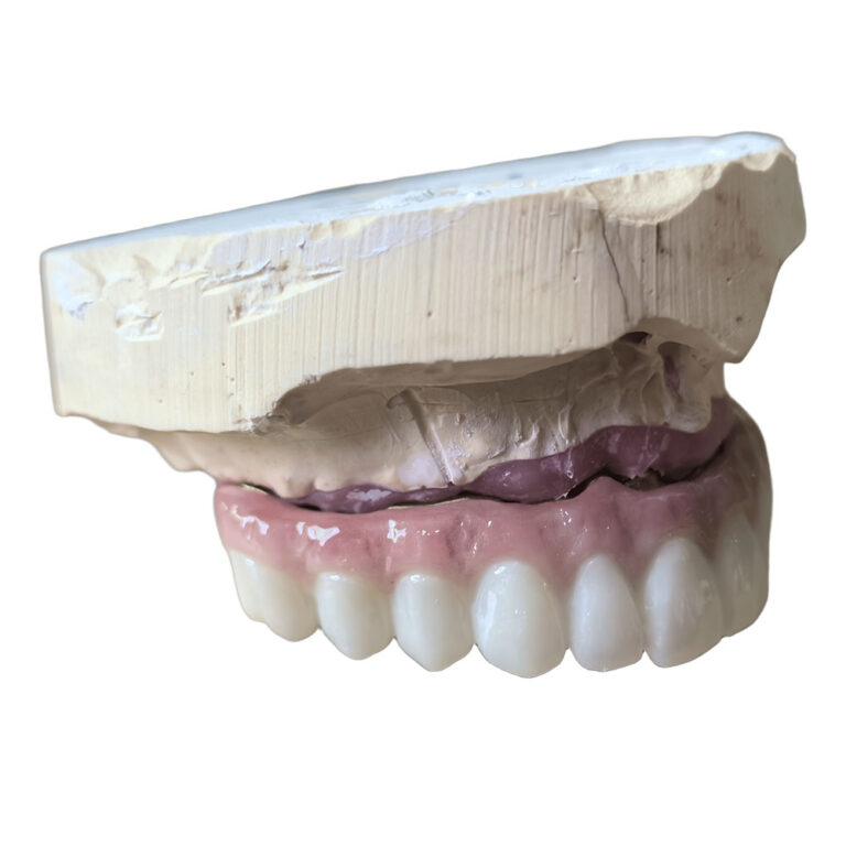 All On 5 Dental Implants