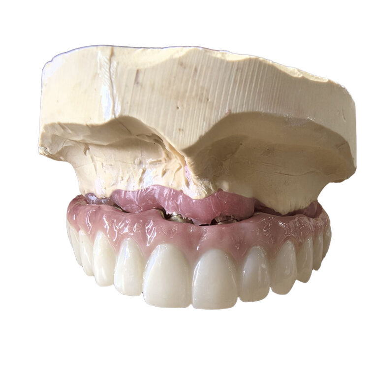 All On 5 Dental Implants