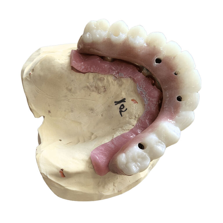 All On 5 Dental Implants