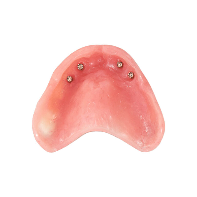 Protesi dentarie All On Four