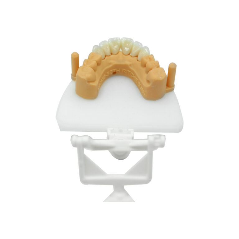 Anterior Zirconia Bridge