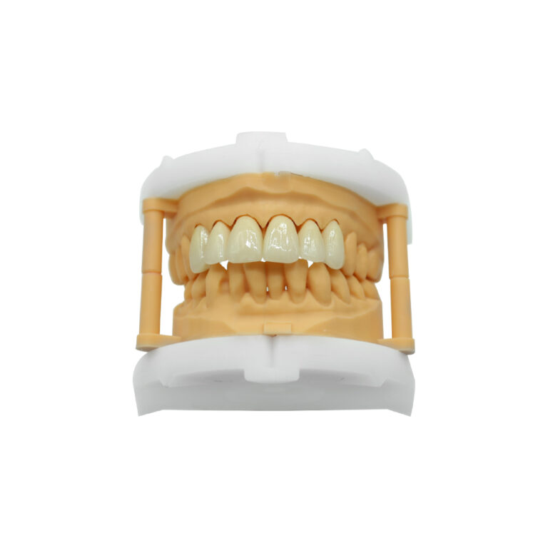 Anterior Zirconia Bridge