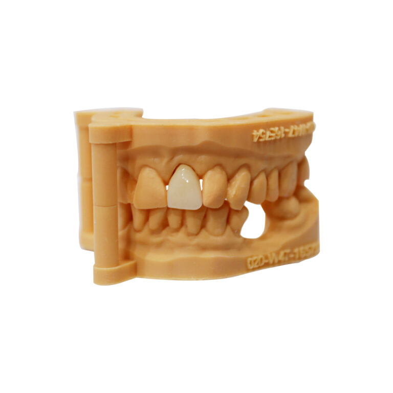 Anterior Zirconia Crown