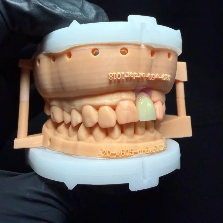 Dental Implant for One Tooth (1)