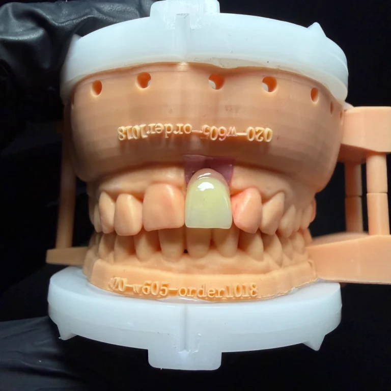 Dental Implant for One Tooth (2)