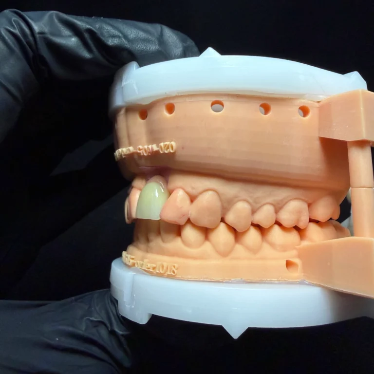 Dental Implant for One Tooth (3)