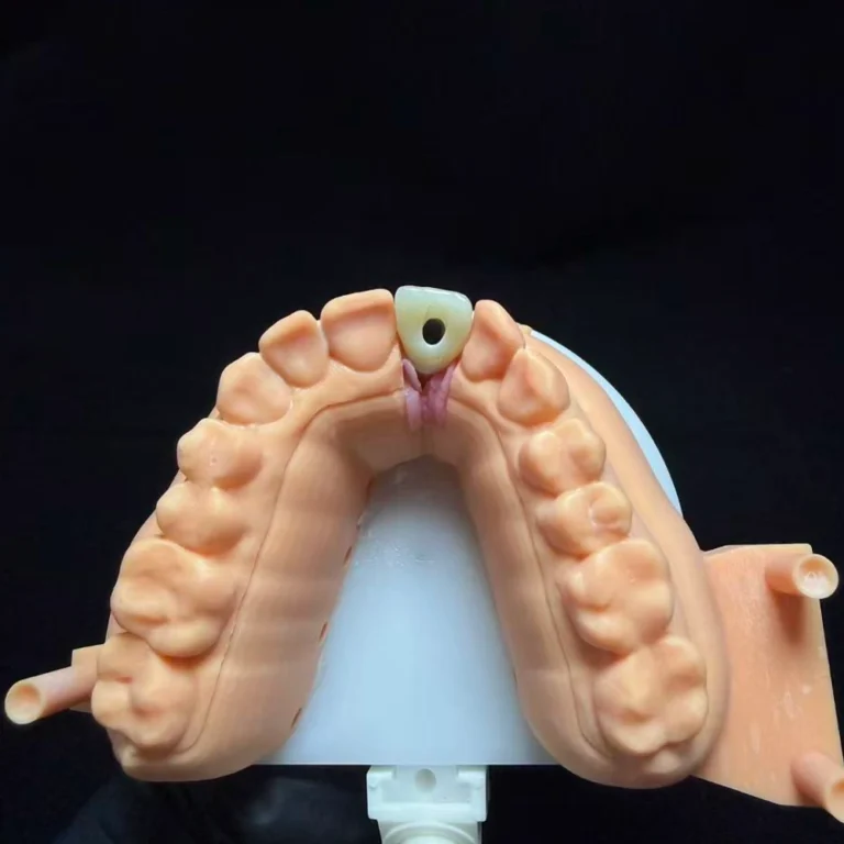 Dental Implant for One Tooth