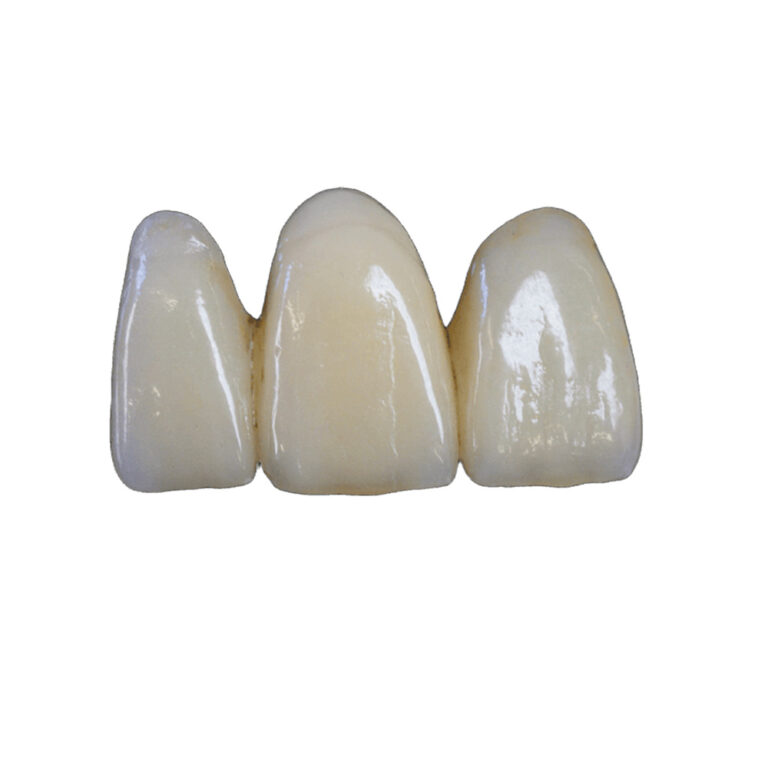 Emax Crowns Front Teeth