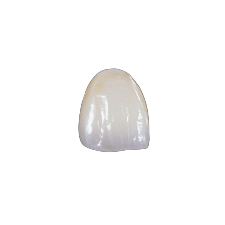 Emax Crowns Front Teeth