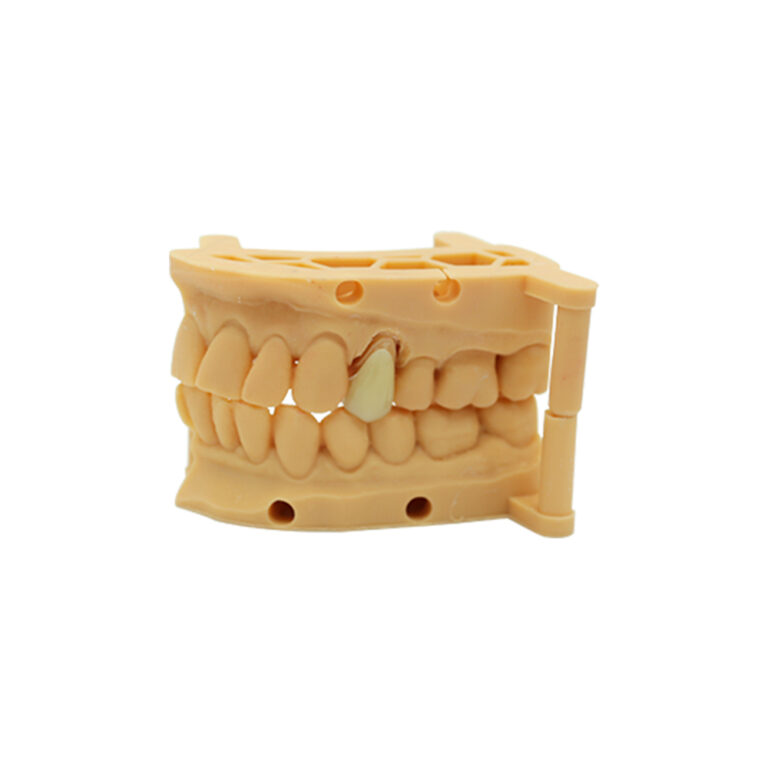 Emax Crowns Front Teeth