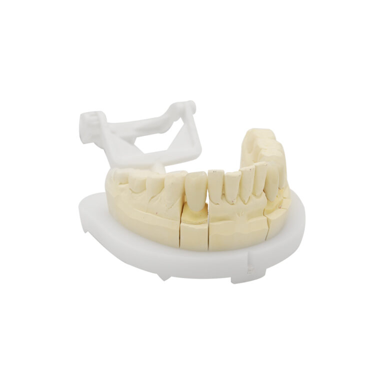 Dente anteriore Corona in porcellana fusa con metallo