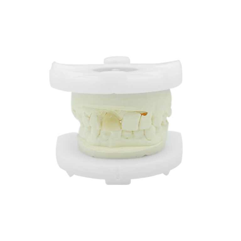 Dente anteriore Corona in porcellana fusa con metallo