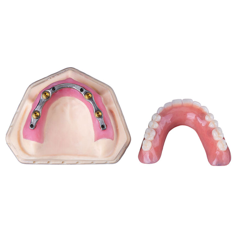 Full Denture Implants