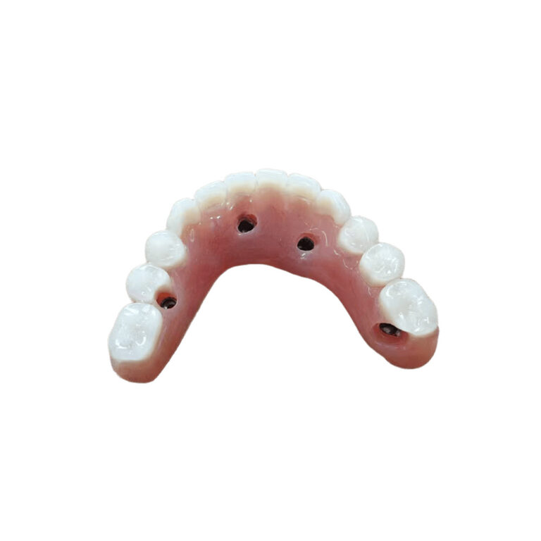 Full Mouth Denture Implants
