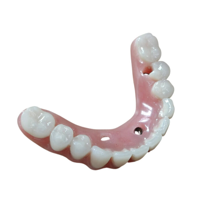 Full Mouth Denture Implants