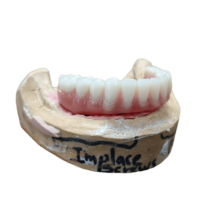 Full Mouth Denture Implants