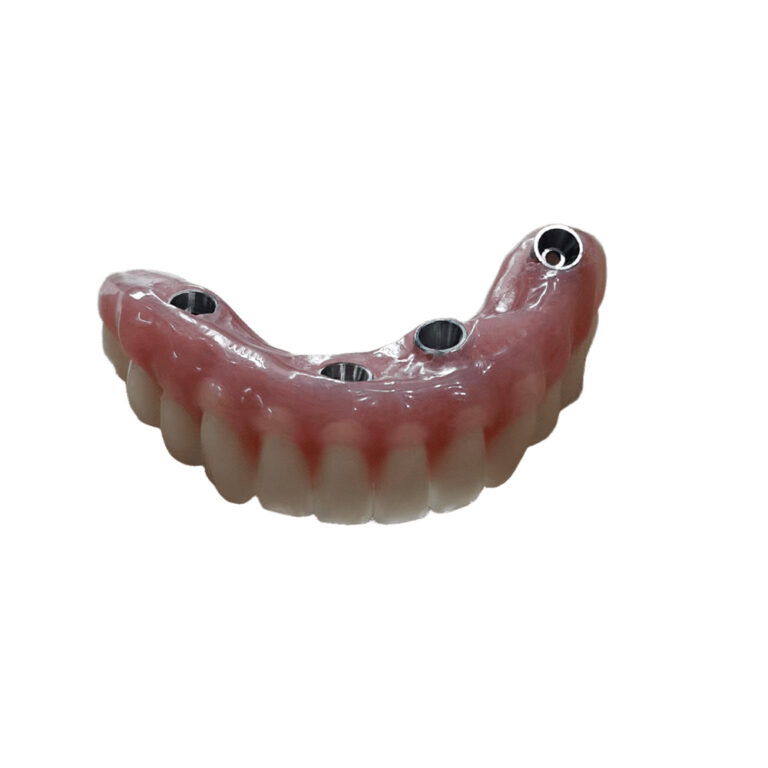 Full Mouth Denture Implants