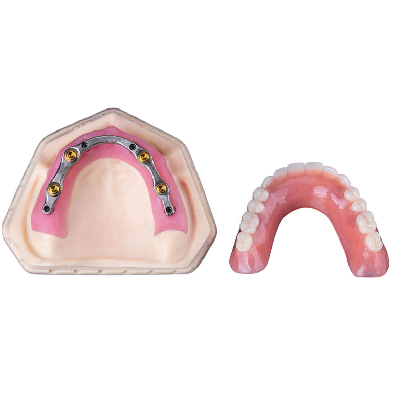 Full Mouth Denture Implants