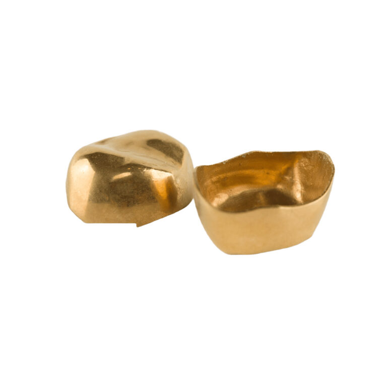 Goldinlays und -onlays