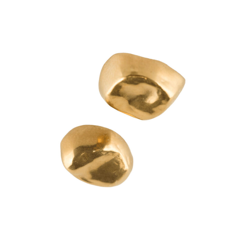 Goldinlays und -onlays