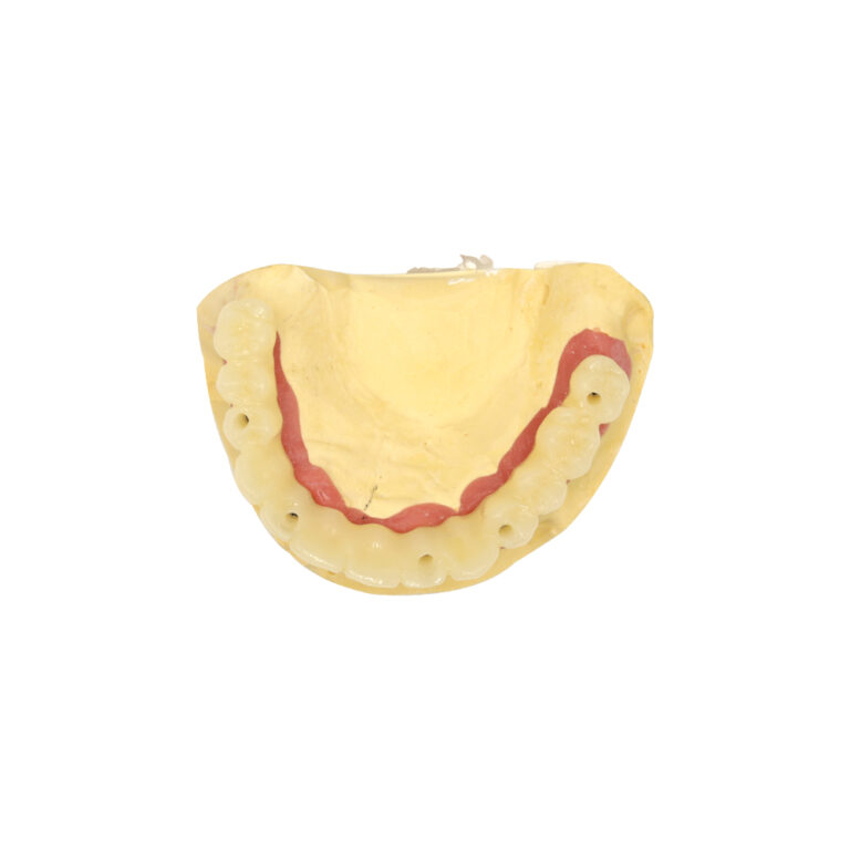 Most dentystyczny wsparty na implantach