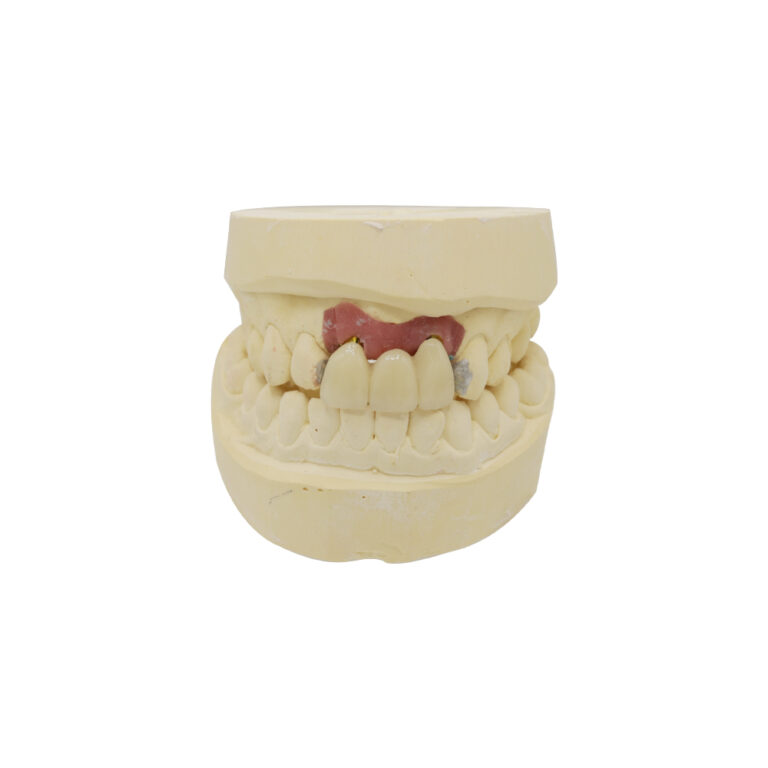 Most dentystyczny wsparty na implantach