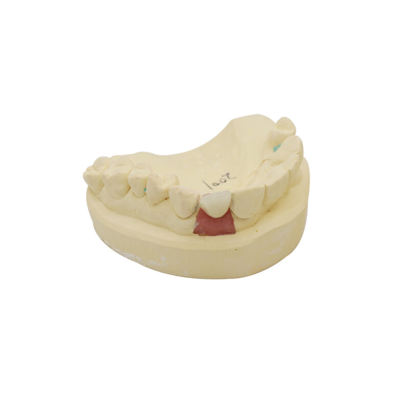 Implant siekacza bocznego