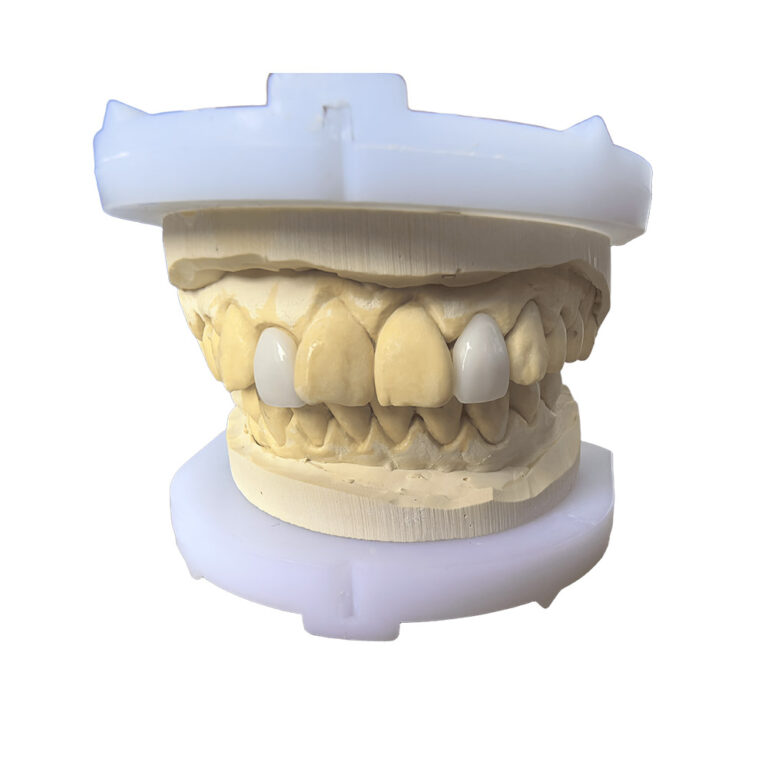 외측 앞니 비니어