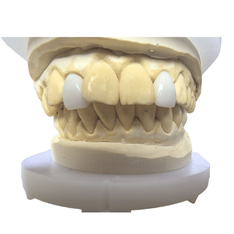 외측 앞니 비니어
