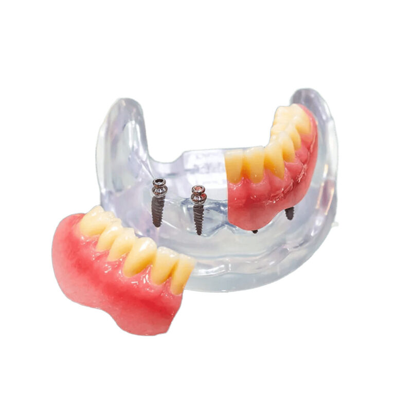 Mini Dental Implants