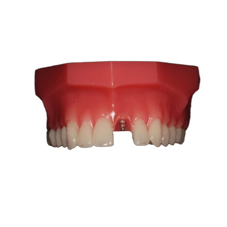 Мини импланти за зъбни протези