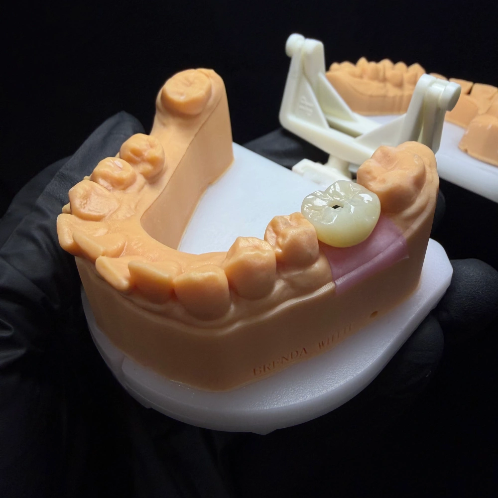 Molar Implant Crown Case