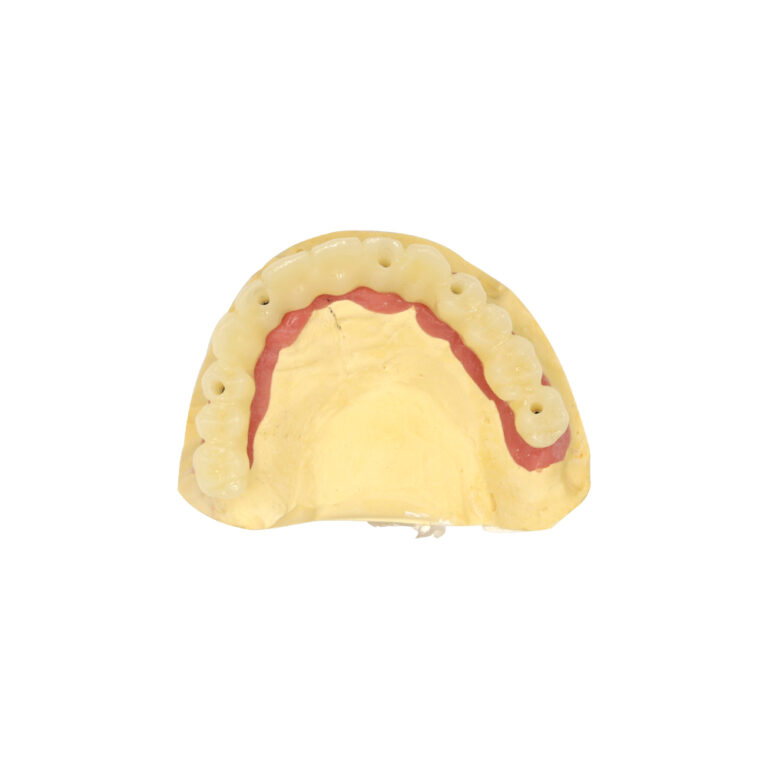 여러 개의 치과 임플란트