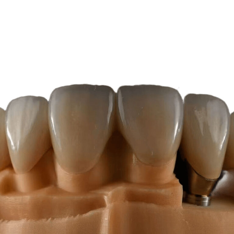 Naturlige hvide tandfinér