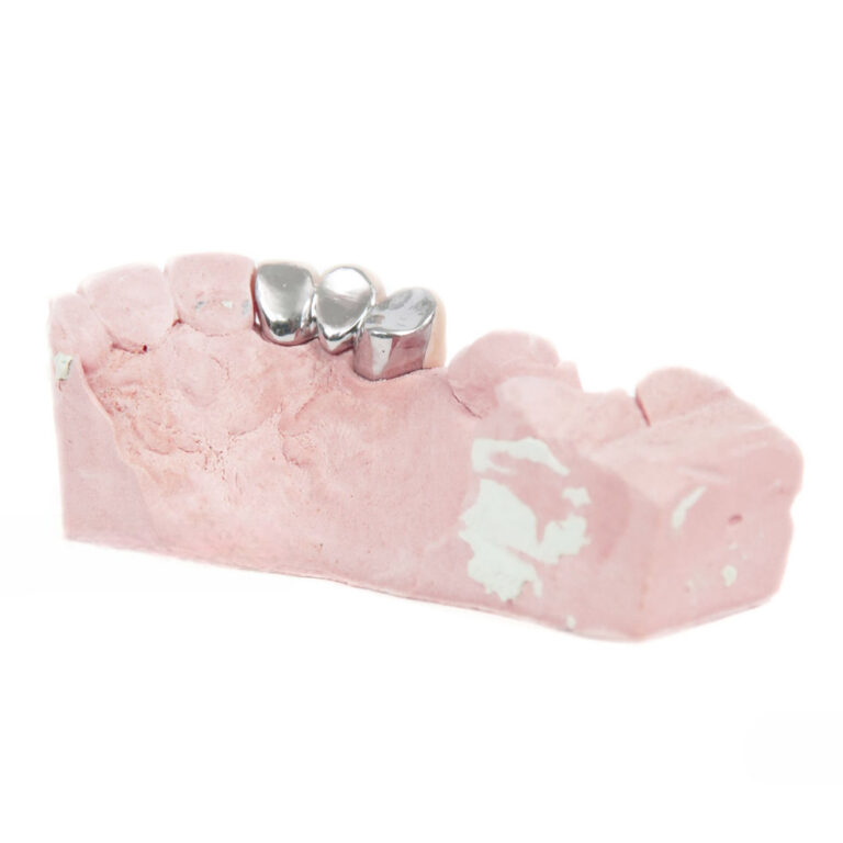 Corona in PFM con linguale in metallo