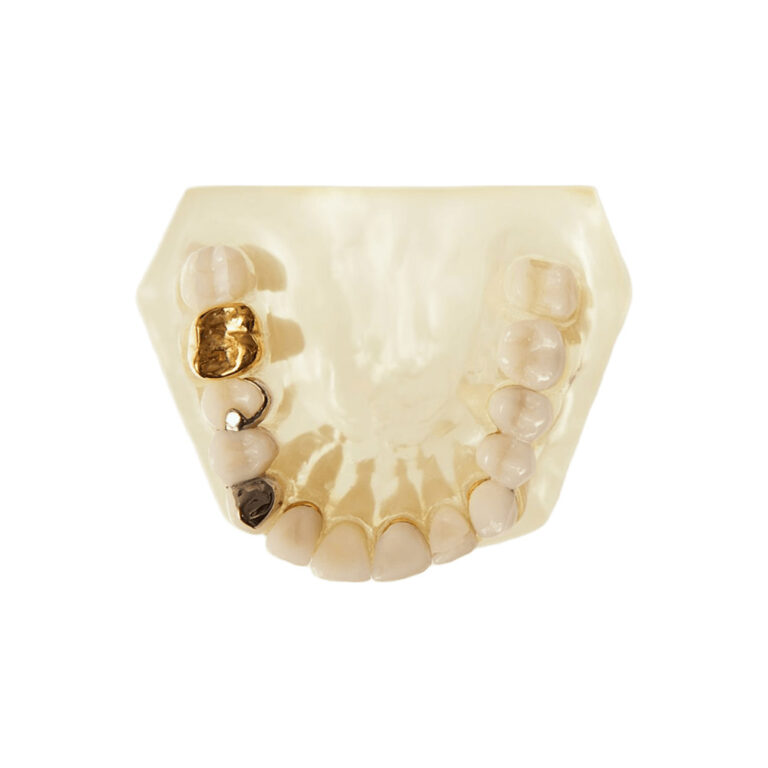 Corona in PFM con linguale in metallo