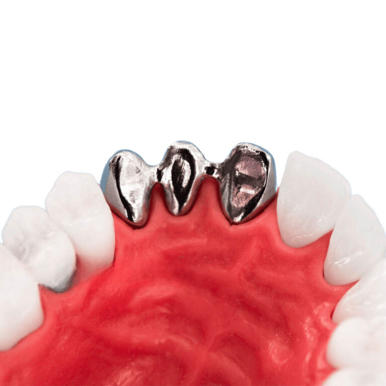 Corona in PFM con linguale in metallo