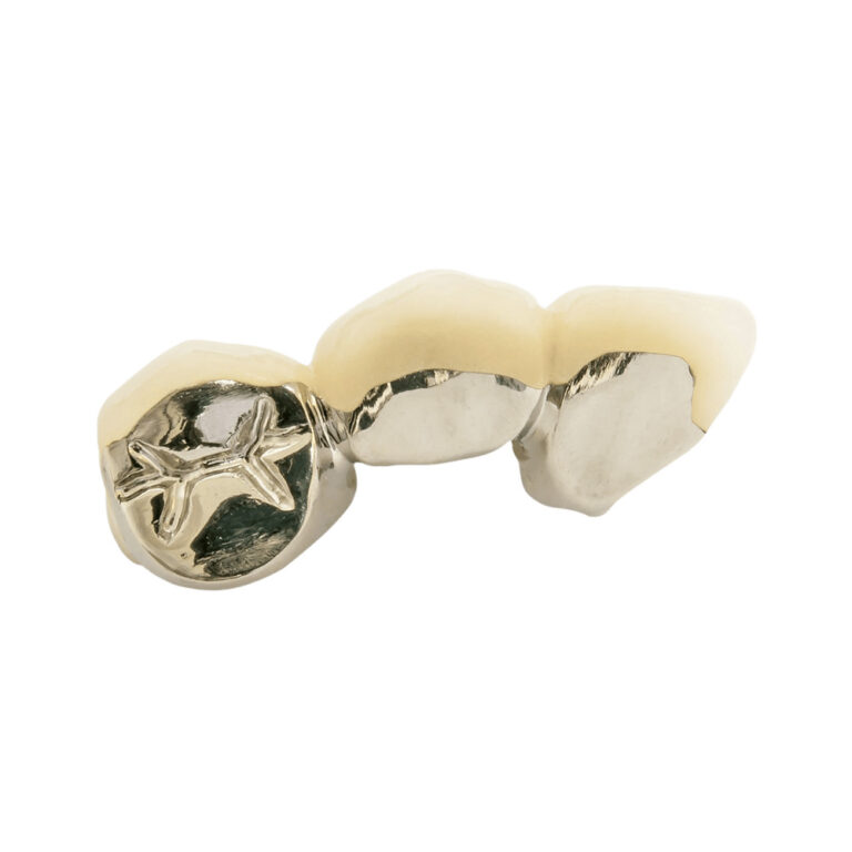 Corona in PFM con linguale in metallo