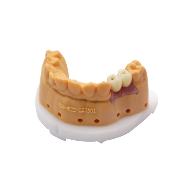 부분 치과 임플란트