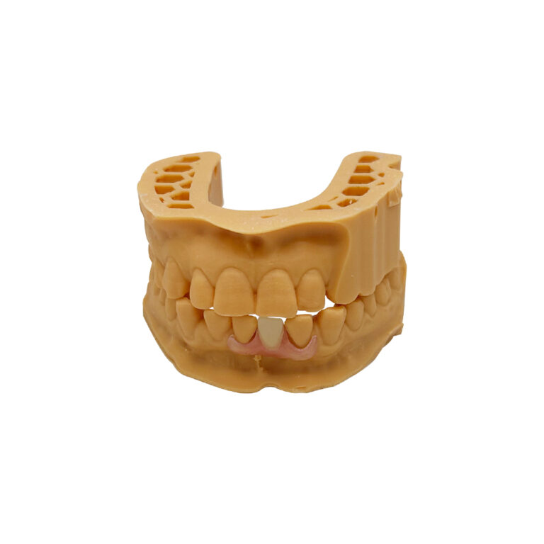Partial Denture without Metal Clasps