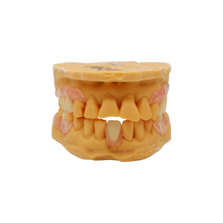 Partial Denture without Metal Clasps