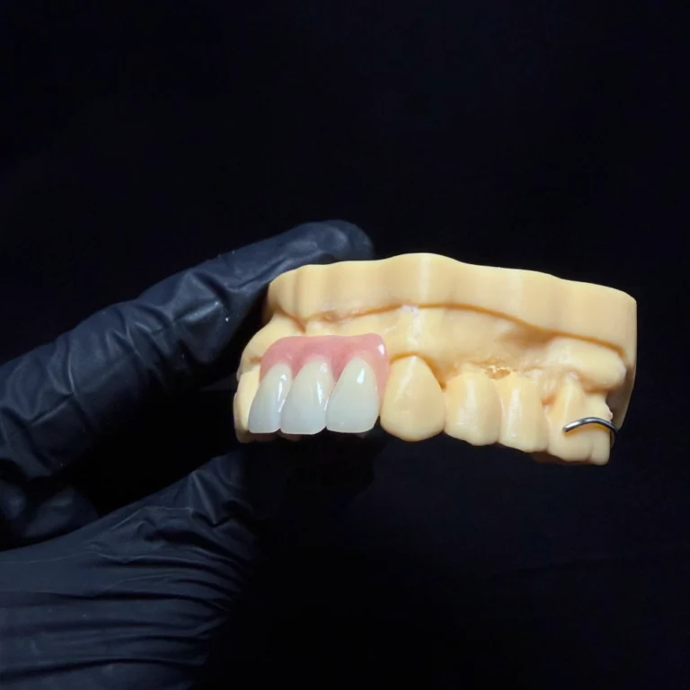 Partial Dentures for Front Teeth (1)