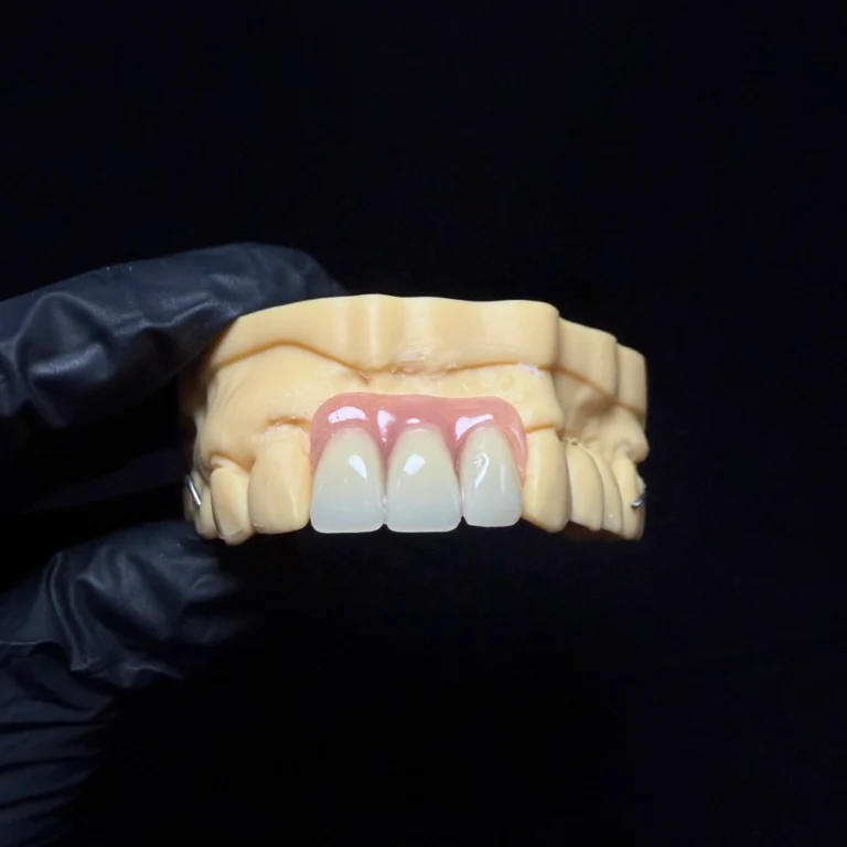 Partial Dentures for Front Teeth (2)
