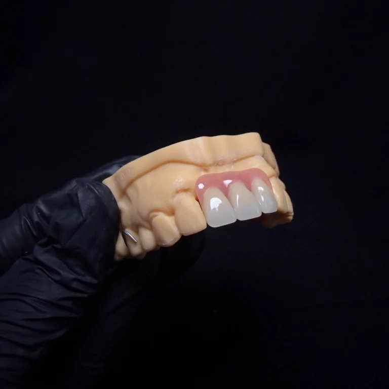 Partial Dentures for Front Teeth
